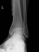SG-Arthrose